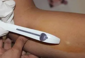 ¿Cuáles son las desventajas de un implante anticonceptivo?