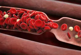 ¿Qué es la trombosis y por qué se considera una enfermedad mortal?