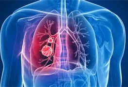 Nueva tecnolog&iacute;a de an&aacute;lisis de sangre basada en el aprendizaje autom&aacute;tico puede detectar c&aacute;ncer de pulm&oacute;n