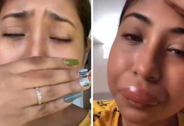 Joven compartió cómo su rostro se deformó luego de ser picado por una abeja