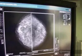 ¿Qué es una mastrografía y por qué es importante realizarla?