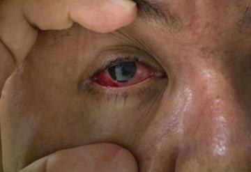 Conjuntivitis, posible síntoma de ómicron