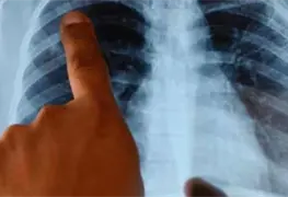 Utilizan gusanos en nueva t&eacute;cnica para detectar c&eacute;lulas de c&aacute;ncer de pulm&oacute;n