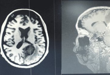 Retiran tumor cerebral maligno del tamaño de un huevo