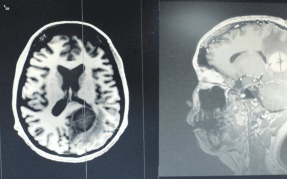 Retiran tumor cerebral maligno del tamaño de un huevo