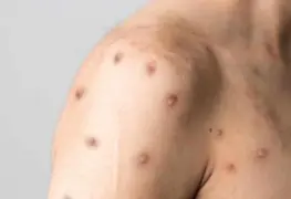 Detectan primer caso de viruela del mono en Baja California Sur