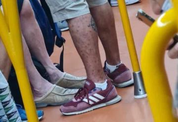 Hombre viaja en el Metro lleno de lesiones de la cabeza hasta los pies de viruela del mono