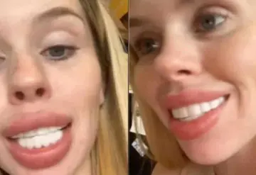 Mujer se hace un "diseño de sonrisa" y el resultado la devastó; Me veo como un caballo