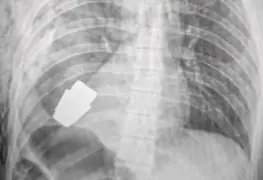 Extraen con éxito una granada del pecho de un soldado ucraniano