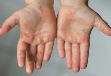 Tras aumento de contagio del virus Coxsackie, primarias en Veracruz suspenden clases