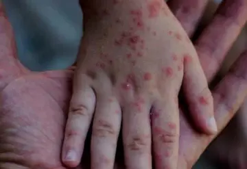 Paraguay confirmó su primer caso de sarampión en 25 años