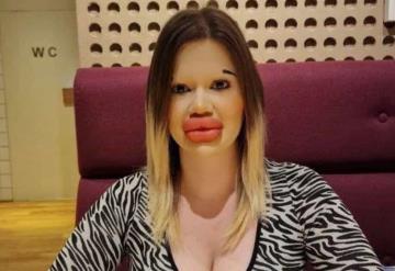 Esta influencer tiene los labios más grandes del mundo