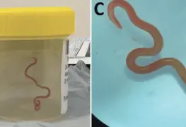 Hallan lombriz intestinal en el cerebro de una mujer