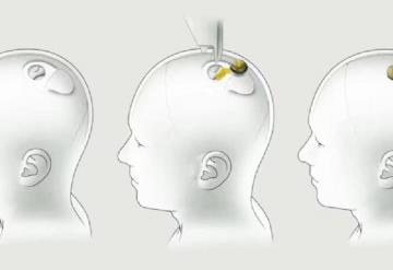 Implante cerebral, primer ensayo en humanos