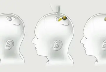 Implante cerebral, primer ensayo en humanos