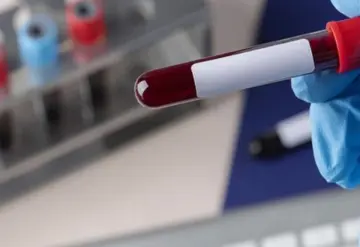 Sangre con VIH afectó a 30 mil pacientes en Reino Unido