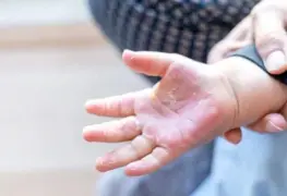 ¿Que hacer si tu bebé se sufre una quemadura?