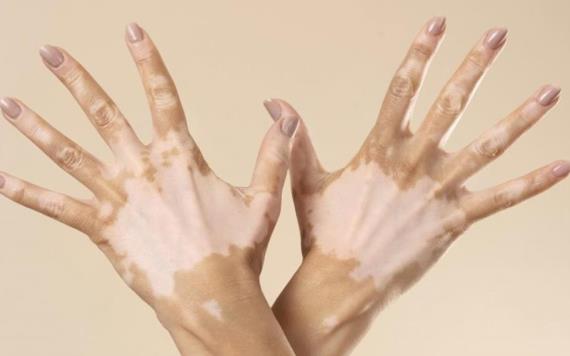 Vitiligo afecta a entre el 2 y el 6 por ciento de los mexicanos