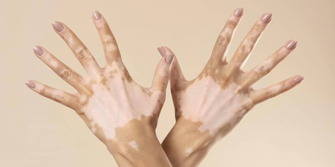 Vitiligo afecta a entre el 2 y el 6 por ciento de los mexicanos