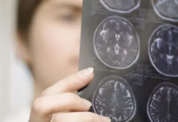 Enfermedades neurológicas en Latinoamérica, sin buen diagnóstico ni tratamiento adecuado