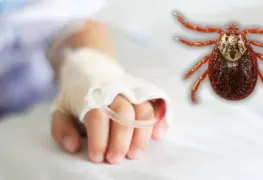 Dos menores mueren por rickettsiosis, picadura de garrapata en Nuevo León