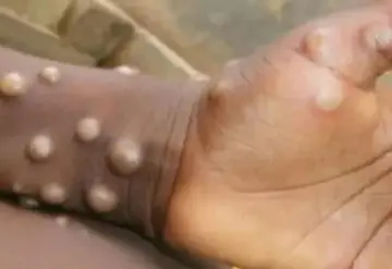 Viruela del mono: Morelos ha registrado 2 casos de mpox en lo que va del año; piden mantener medidas preventivas