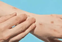 ¿Cómo identificar síntomas de mpox y qué diferencia hay entre las cepas de la viruela del mono?