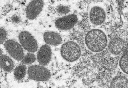 Yo misma me doy asco: mujer relata su sufrimiento tras contagiarse de viruela del mono