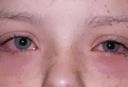 Impactan a Tamaulipas casos de conjuntivitis; ocupa el tercer lugar a nivel nacional