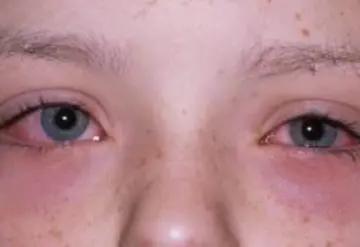 Impactan a Tamaulipas casos de conjuntivitis; ocupa el tercer lugar a nivel nacional