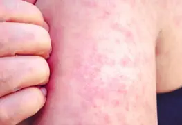 México publica una nueva alerta epidemiológica sobre sarampión; pone en alerta casos importados