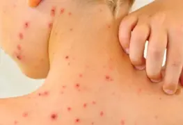 En México se duplicaron los casos de sarampión; se contabilizan 126