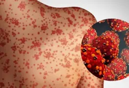 El sarampión llega a Yucatán y Tabasco