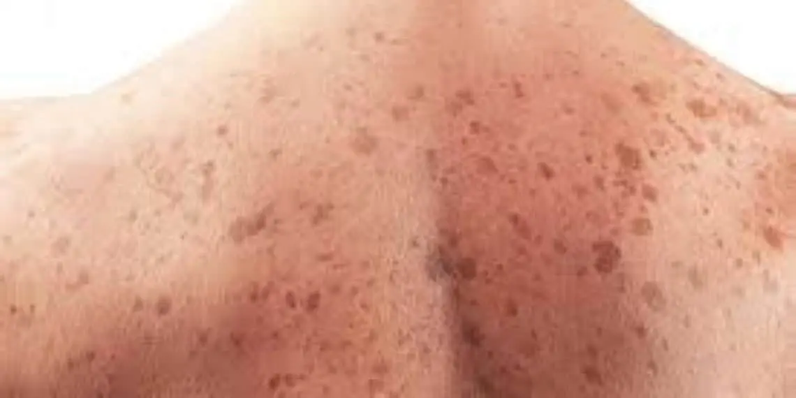 Melanoma en aumento por exposición solar