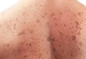 Melanoma en aumento por exposición solar