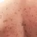 Melanoma en aumento por exposición solar