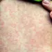 Alerta sanitaria