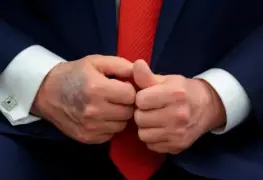 Moretones en la mano de Trump: ¿Qué ocurre realmente?
