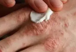 Se encienden alertas sanitarias por lepra en México