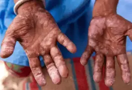 Aumentan casos de lepra en América