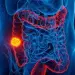 Aumento preocupante de casos de c&aacute;ncer colorrectal en j&oacute;venes