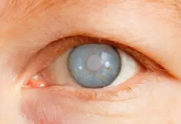 Glaucoma llamado a la prevención y detección