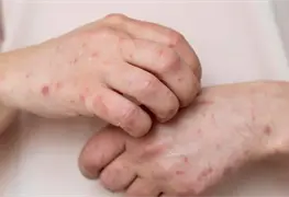 Autoridades detectan sarampi&oacute;n en aeropuertos de EE. UU. en diciembre