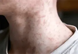 M&aacute;s de siete mil casos confirmados de sarampi&oacute;n en el pa&iacute;s