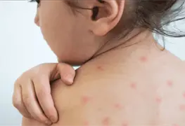 Vacunaci&oacute;n como medida preventiva contra sarampi&oacute;n