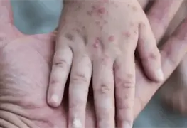 Beb&eacute; de 8 meses intubada por sarampi&oacute;n en Jalisco