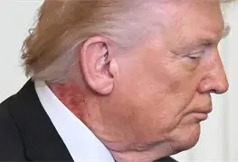 Donald Trump y su tratamiento para la erupci&oacute;n en el cuello