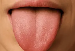 &iquest;Qu&eacute; dice el color de tu lengua sobre tu salud?